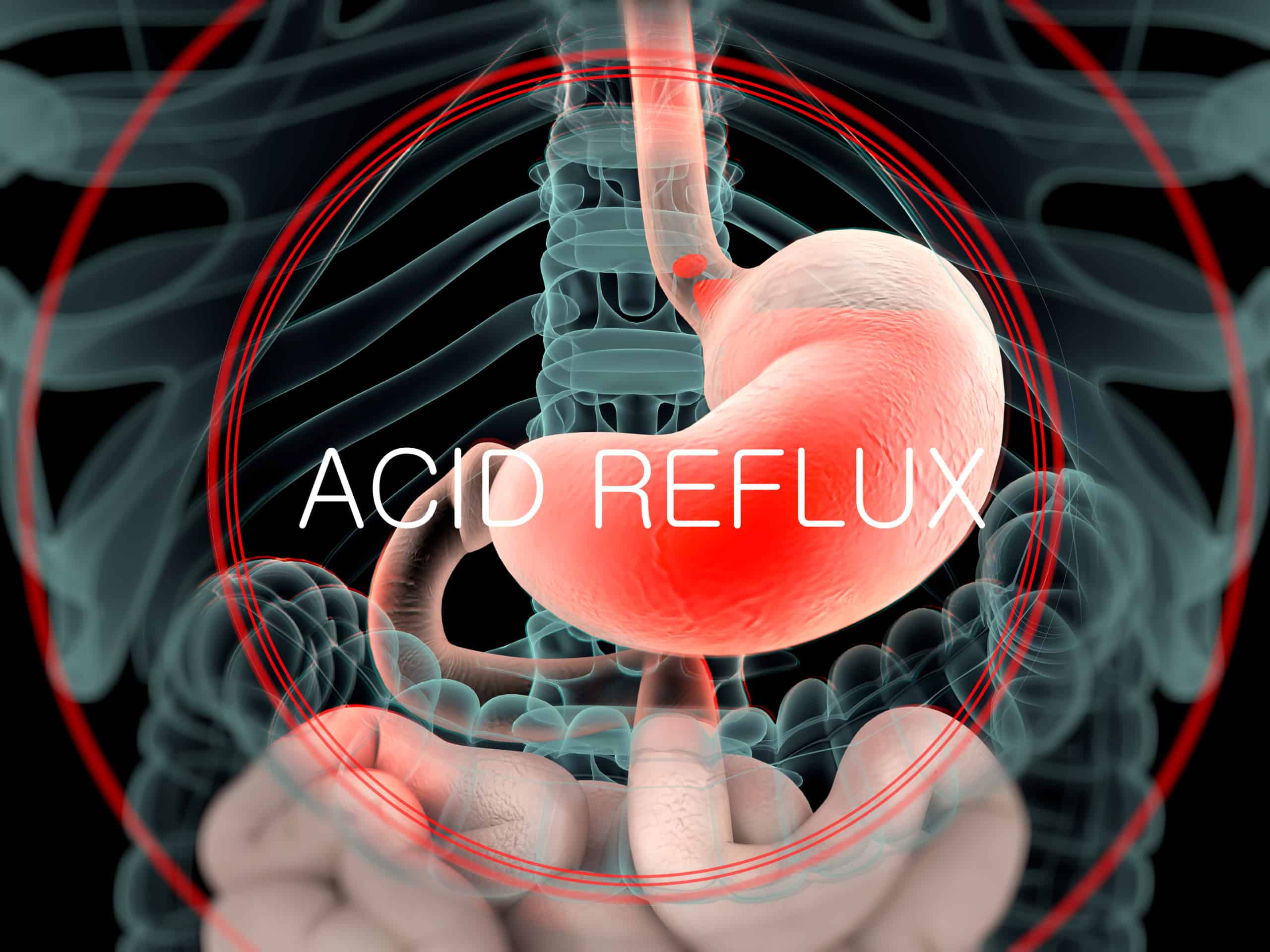 What acid reflux looks like